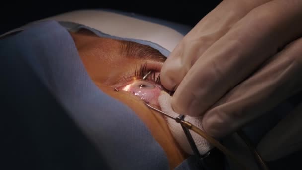 Laserowa Korekcja Wzroku Pacjent Zespół Chirurgów Sali Operacyjnej Podczas Operacji — Wideo stockowe