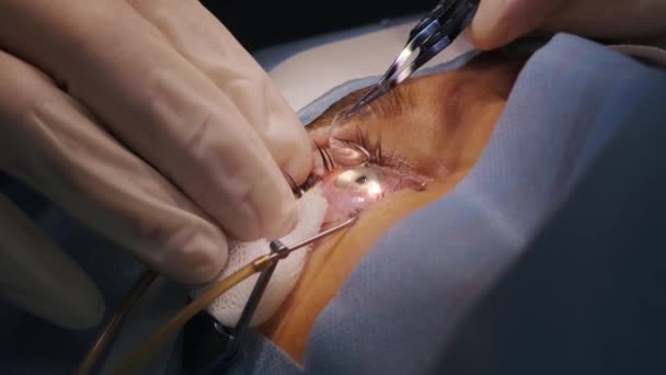 Laser Vision Correction Patient Team Surgeons Operating Room Ophthalmic Surgery — Stock Video