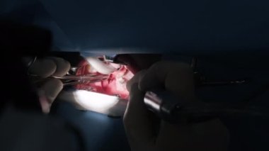 Operation of removing tonsils under deep anesthesia, throat close up, surgeon uses latest devices, cold plasma method, cuts swelling in throat, doctor works with new probe