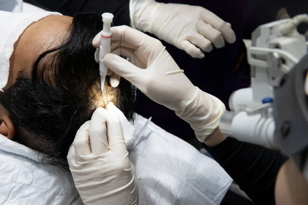 Hair transplantation process, pulling hair follicles back and replanting them. Riyadh Saudi Arabia 2019