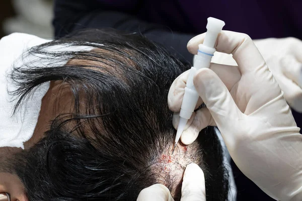 Hair Transplantation Process Pulling Hair Follicles Back Replanting Them — Stock Photo, Image