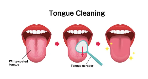 Cómo Limpiar Ilustración Del Vector Lengua Prevención Halitosis — Archivo Imágenes Vectoriales