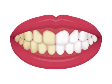 Diş beyazlatma vektörü illüstrasyonu / öncesi ve sonrası 