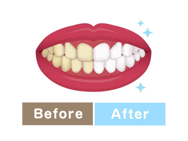 Illustration Vectorielle Blanchiment Des Dents Avant Après — Image vectorielle