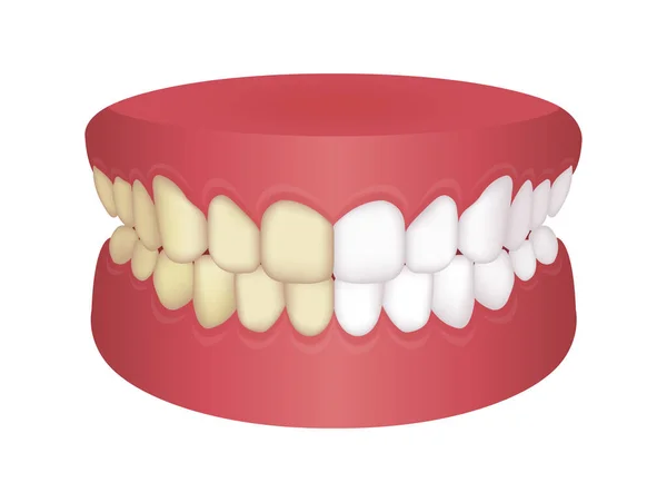 Illustration Vectorielle Blanchiment Des Dents Avant Après — Image vectorielle