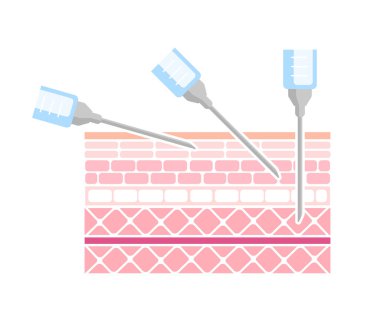 Enjeksiyon vektörü illüstrasyonu için açılar