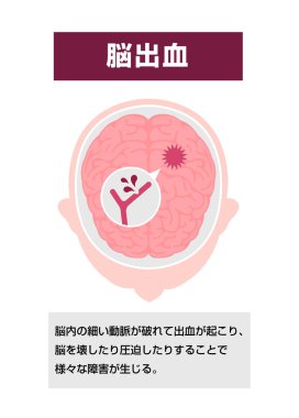 İnsan beyni felçli vektör illüstrasyonunun türleri: 124; Beyin kanaması