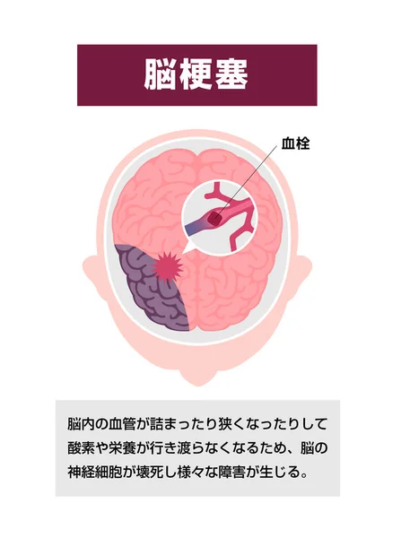 脳梗塞の種類ベクトル図 脳梗塞 — ストックベクタ