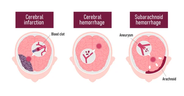 Tipos Ilustração Vetor Acidente Vascular Cerebral Humano — Vetor de Stock