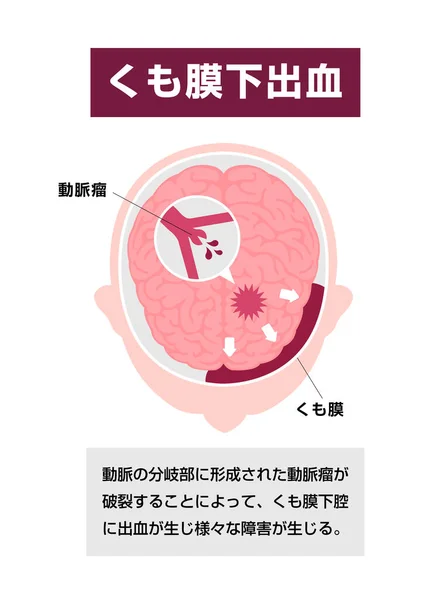 Types Human Brain Stroke Vector Illustration Subarachnoid Hemorrhage — 스톡 벡터