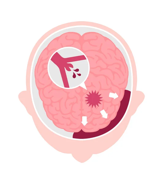 Types Human Brain Stroke Vector Illustration Subarachnoid Hemorrhage — ストックベクタ
