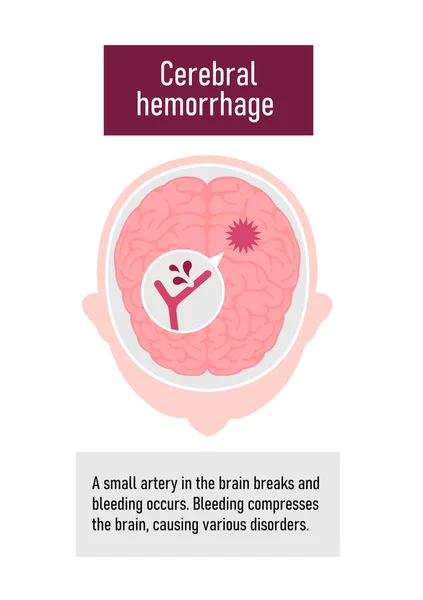 Tipos Acidente Vascular Cerebral Humano Ilustração Vetor Hemorragia Cerebral — Vetor de Stock