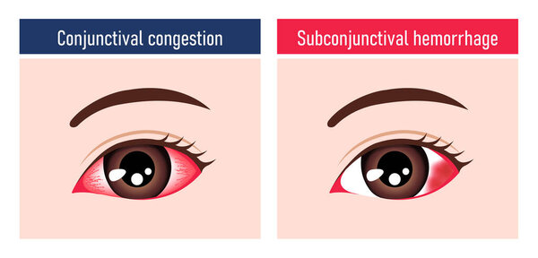 Illustration comparing subconjunctival hemorrhage and conjunctival congestion