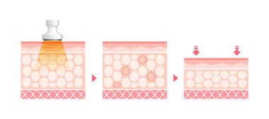 Kavitasyonun nasıl işlediğinin vektör illüstrasyonu