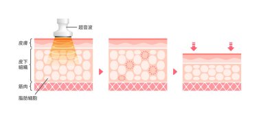 Kavitasyonun nasıl işlediğinin vektör illüstrasyonu