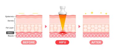 HIFU mekanizmasının ve etkisinin vektör illüstrasyonu.