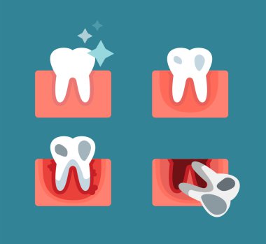 Periodontal disease stage steps vector illustration
