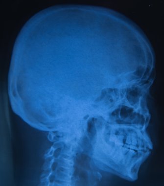 View of  film x-ray skull of human clipart