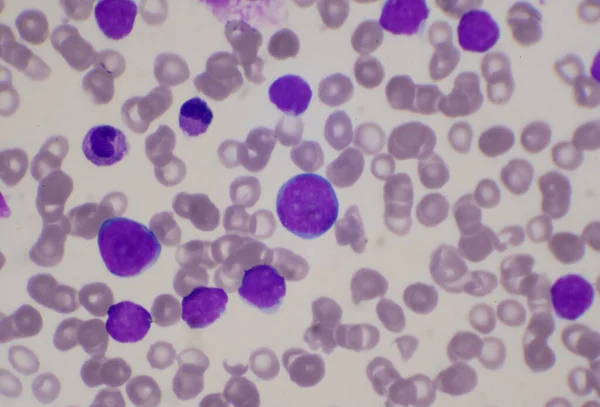 Blastocitos Moderados Glóbulos Blancos Frotis Sangre Leucemia Imagen Sangre —  Fotos de Stock