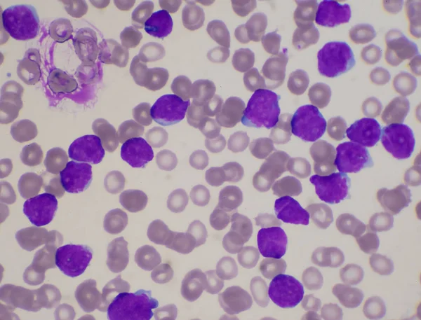 Blastocitos Moderados Glóbulos Blancos Frotis Sangre Leucemia Imagen Sangre —  Fotos de Stock