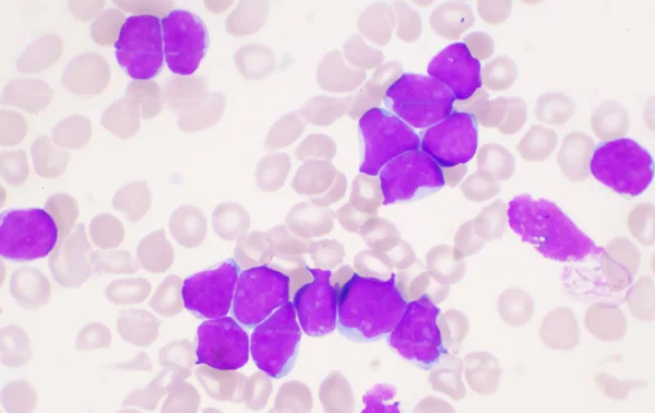 Mérsékelt Blasztos Sejt Fehérvérsejtek Vérkenet Leukémia Vérkép — Stock Fotó