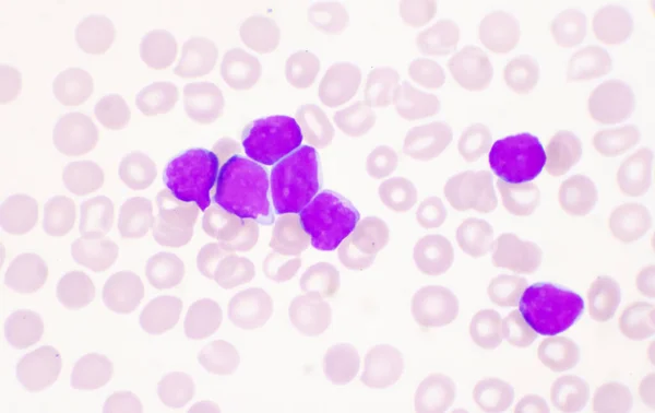 血液中の白血球の中程度の芽細胞 白血病の血液像 — ストック写真