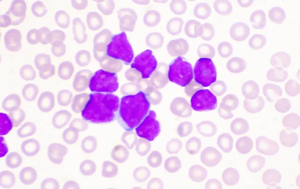 Mérsékelt Blasztos Sejt Fehérvérsejtek Vérkenet Leukémia Vérkép — Stock Fotó