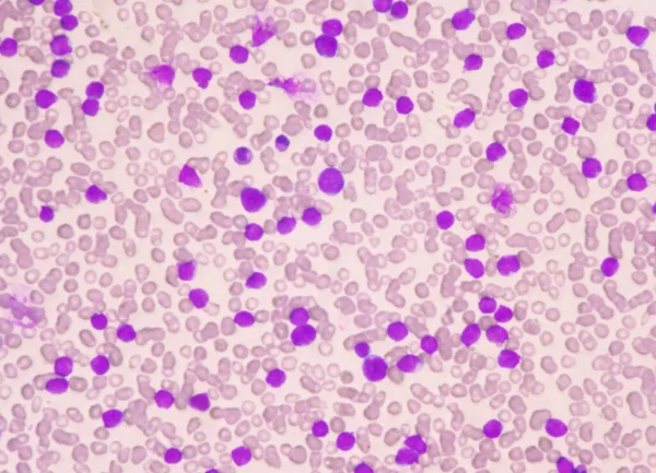 Matige Blastaire Cel Van Witte Bloedcellen Bloeduitstrijk Leukemie Bloedbeeld — Stockfoto