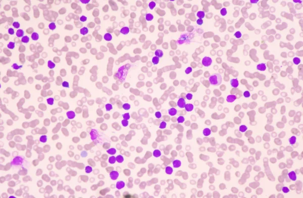 血液中の白血球の中程度の芽細胞 白血病の血液像 — ストック写真