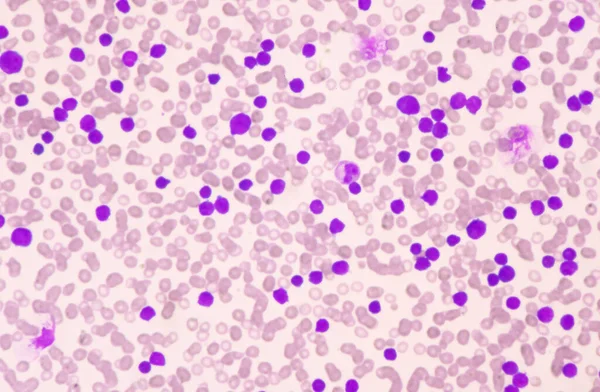 Célula Blástica Moderada Glóbulos Brancos Esfregaço Sanguíneo Leucemia Imagem Sangue — Fotografia de Stock