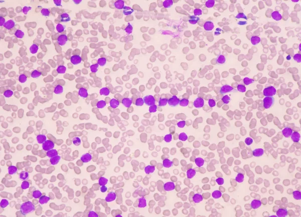 Célula Blástica Moderada Glóbulos Brancos Esfregaço Sanguíneo Leucemia Imagem Sangue — Fotografia de Stock
