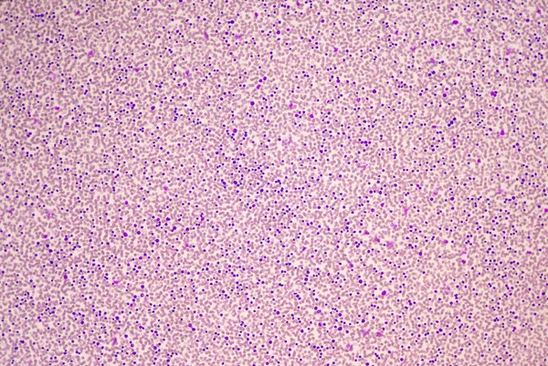 Umiarkowane Komórki Blastyczne Białych Krwinek Rozmazie Krwi Obraz Krwi Białaczki — Zdjęcie stockowe