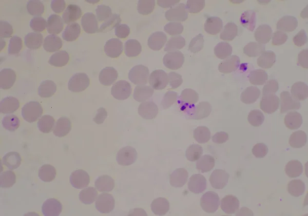 Malária Parasita Sangue Infectados Glóbulos Vermelhos Conceito Médico — Fotografia de Stock