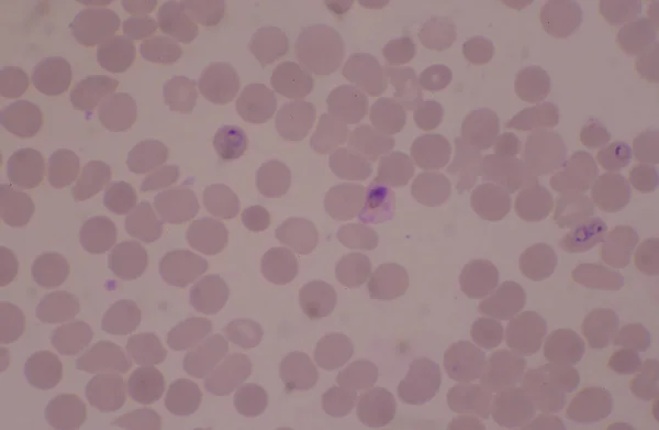 Malaria Parasite Sanguin Infecté Globules Rouges Concept Médical — Photo