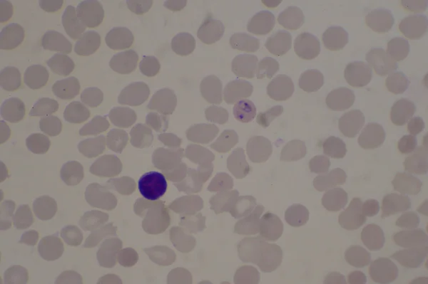 Malaria Sangue Parasit Infetti Globuli Rossi Concetto Medico — Foto Stock