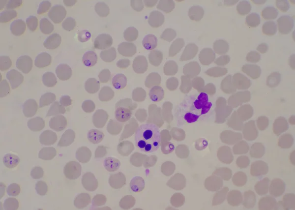Ring Vorm Malaria Bloed Parasiet Geïnfecteerd Rode Bloedcellen Medische Achtergrond — Stockfoto