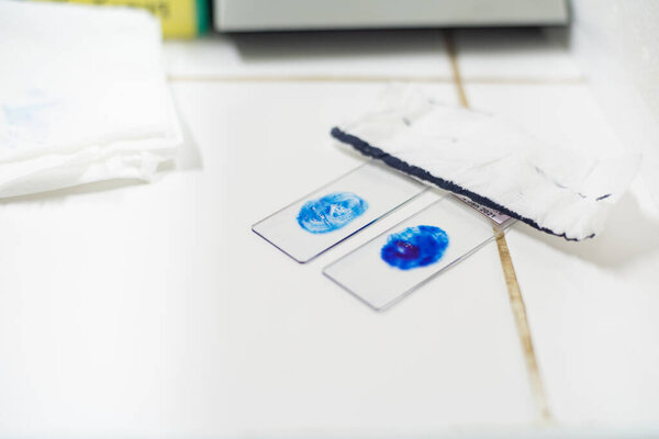 Sputum sample diag Mycrobacterium tuberculosis in laboratory.