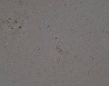 İdrar tahlilinde orta dereceli bakteriler..