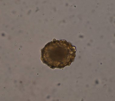 Ascaris lumbricoides yumurtası dışkı muayenesinde.