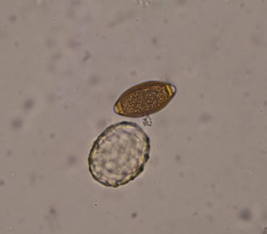 Dışkı testinde Ascaris lumbricoides ve Trichulis trichiura yumurtası karışımı..