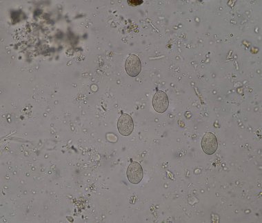 Dışkı muayenesinde Protozao entamoeba histolytica cyte safhası.