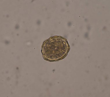 Ascaris lumbricoides yumurtası dışkı muayenesinde.
