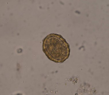 Ascaris lumbricoides yumurtası dışkı muayenesinde.