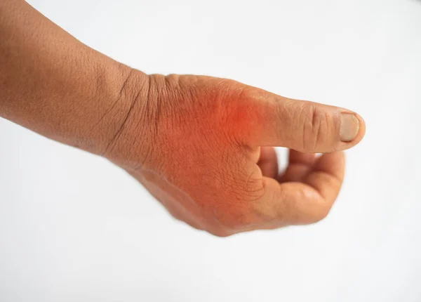 Close Hand Suffering Joint Pain Gout — Stock Photo, Image