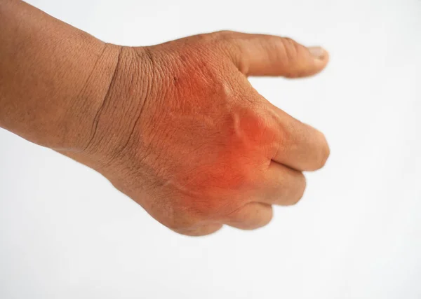 Закройте Руки Страдающие Боли Суставах — стоковое фото