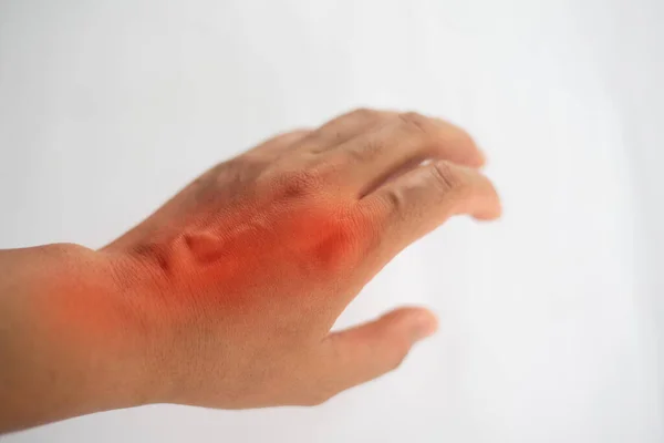 Close Mão Sofrendo Dor Nas Articulações Com Gota — Fotografia de Stock