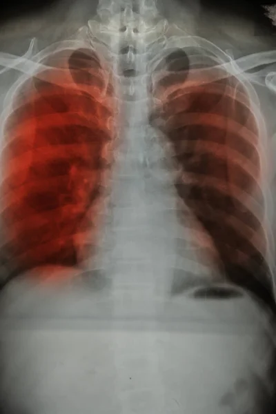 Chest Ray Patient Covid Medical Science Concept — Stock Photo, Image