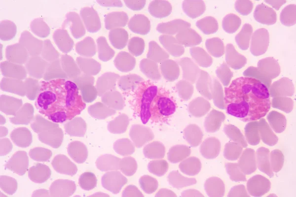 Grânulo Laranja Eosinófilos Glóbulos Brancos Sobre Fundo Glóbulos Vermelhos — Fotografia de Stock