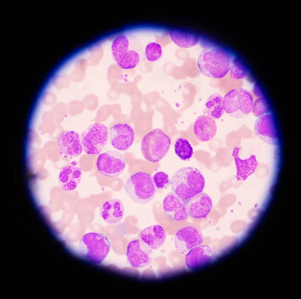 Fase Mista Glóbulos Brancos Fundo Dos Glóbulos Vermelhos Conceito Leucemia — Fotografia de Stock