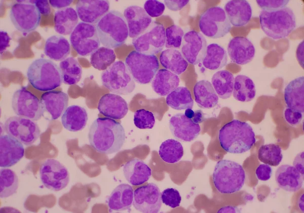 Fase Mista Glóbulos Brancos Fundo Dos Glóbulos Vermelhos Conceito Leucemia — Fotografia de Stock
